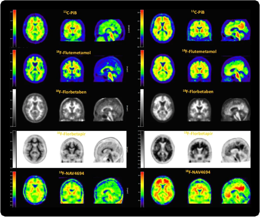 New AMYPAD state-of-the-art review on the quantification of amyloid PET for future clinical use
